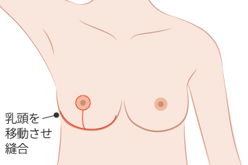 乳房縮小術の解説画像