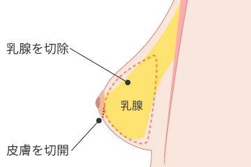 女性化乳房乳腺除去の解説画像