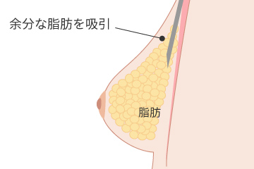 女性化乳房脂肪吸引の解説画像