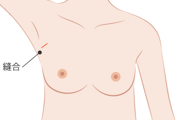 副乳の解説画像