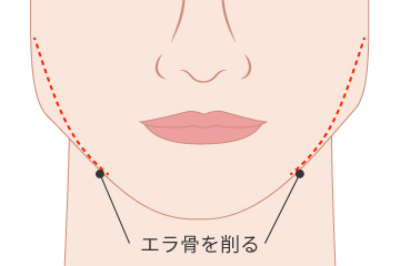 エラ削りの解説画像