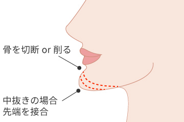 顎削りの解説画像