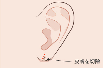 耳垂裂直線法の解説画像