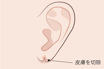 耳垂裂Z型形成術の解説画像