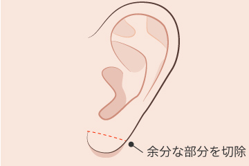 耳垂縮小の解説画像