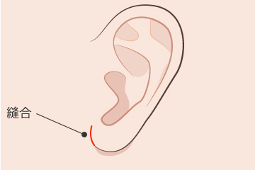 耳垂縮小の解説画像