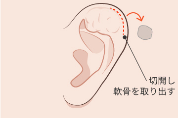 柔道耳修正の解説画像