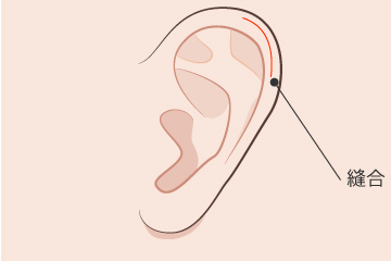 柔道耳修正の解説画像