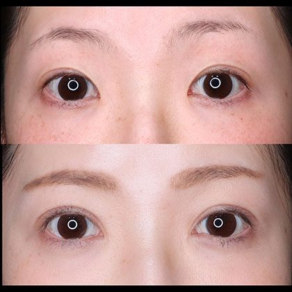 切開二重、目頭切開