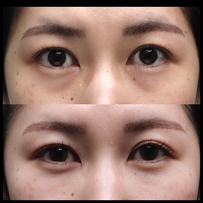 目の下脱脂、脂肪注入