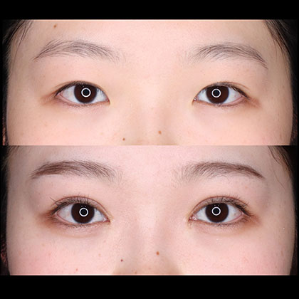 切開二重、目頭切開02