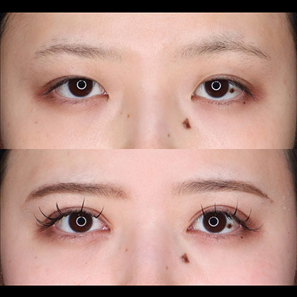 眼瞼下垂03