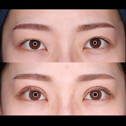 切開二重