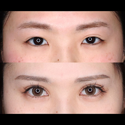 切開二重、目頭切開
