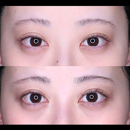 切開二重、目頭切開、他院修正