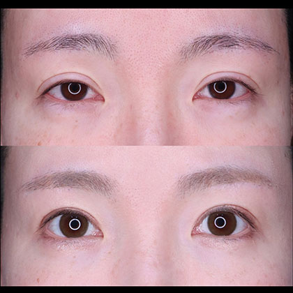 眼瞼下垂