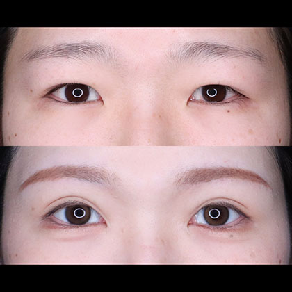 眉下皮膚切除、切開二重、目頭切開