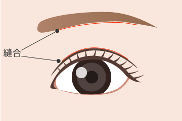 眼窩脂肪・ROOF除去の解説画像