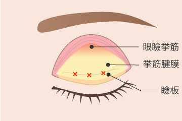 眼瞼下垂の解説画像