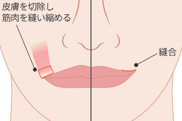 口角挙上術手術の解説画像