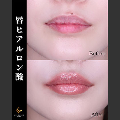 口唇ヒアルロン酸