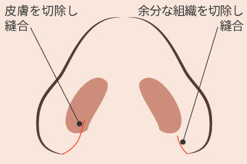 鼻翼縮小術の解説画像