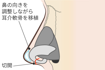 耳介軟骨移植の解説画像