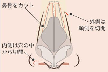鼻骨骨切り術の解説画像