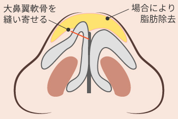 鼻尖形成術の解説画像
