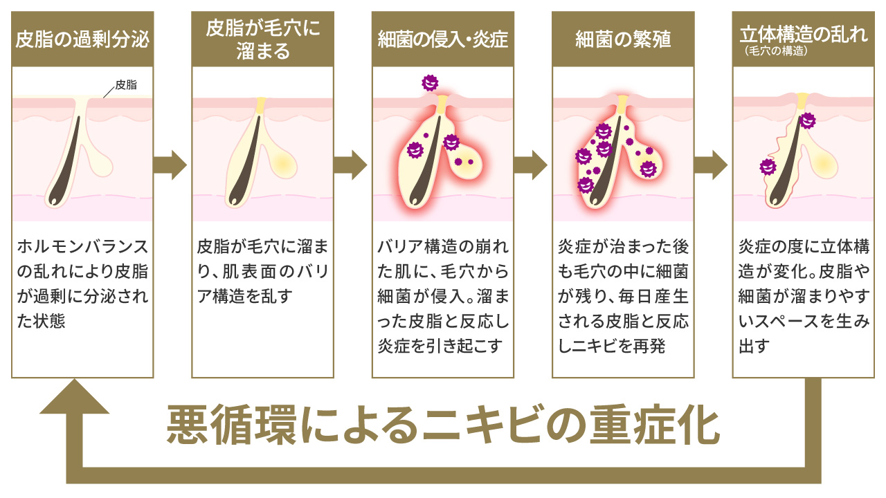 悪循環によるニキビの重症化