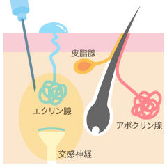 腋臭症(ワキガ)・ボトックス治療の内容02