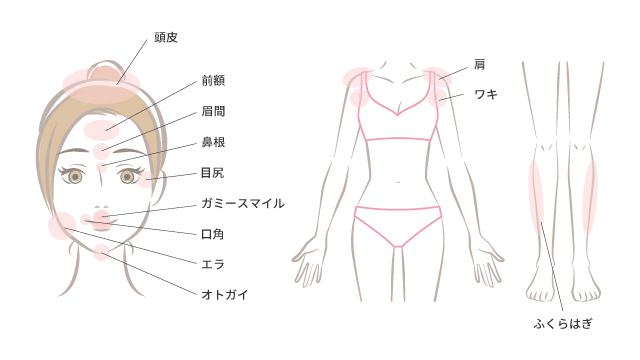 ボトックス注射の効果と有効な部位