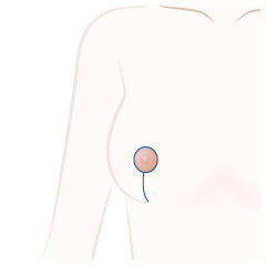 乳房吊り上げの手術内容02