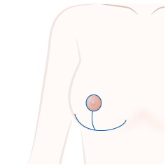 乳房縮小術の手術内容02