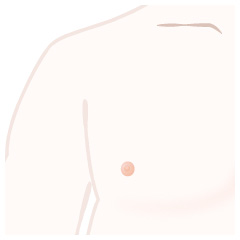 女性化乳房(脂肪吸引)の手術内容03