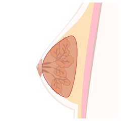 女性化乳房(乳腺除去)の手術内容02