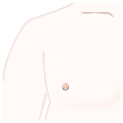 女性化乳房(乳腺除去)の手術内容03