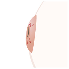 陥没乳頭修正術の手術内容01