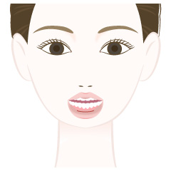 顎形成術(プロテーゼ)の手術内容01