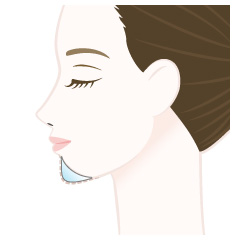 顎形成術(プロテーゼ)の手術内容02