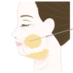 脂肪吸引の手術内容01