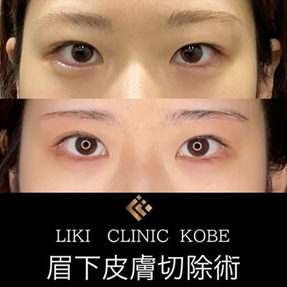 眉下皮膚切除術