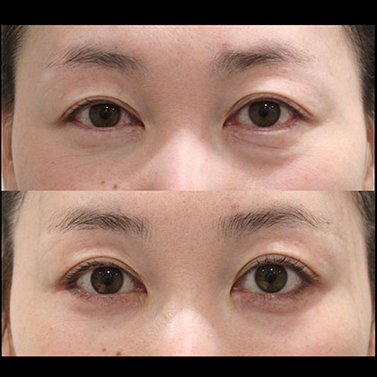 経皮的眼窩脂肪移動術(表ハムラ法)