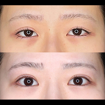 眼瞼下垂術、他院修正