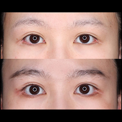 たれ目形成術、他院修正