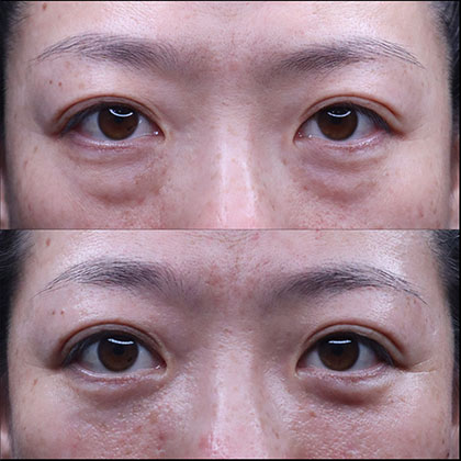 経結膜的眼窩脂肪移動術(裏ハムラ法)