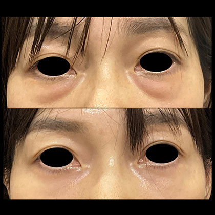 経結膜的眼窩脂肪移動術(裏ハムラ法)