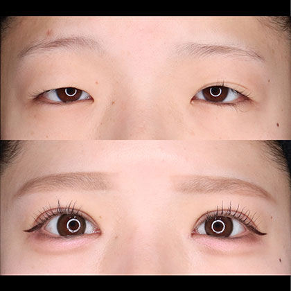 眼瞼下垂術、目頭切開