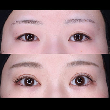 切開二重、目頭切開術