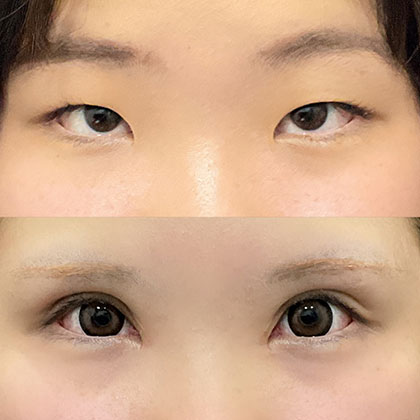眼瞼下垂術、目頭切開術